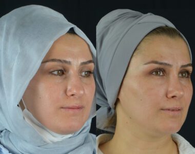 22-380x300