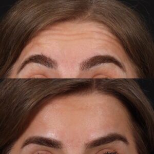Botox-10-2-300x300