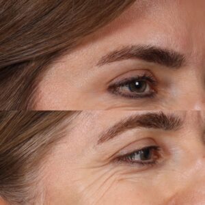 Botox-10-3-300x300