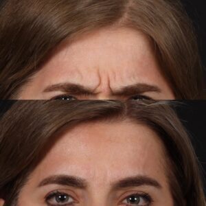 Botox-10-300x300