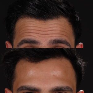 Botox-11-2-300x300