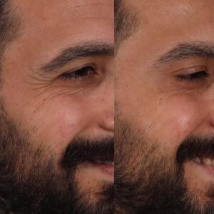 Botox-11-300x300