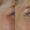 Botox-2-2-300x300