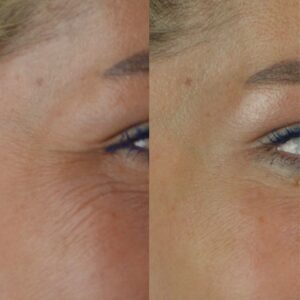 Botox-2-2-300x300