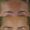 Botox-2-3-300x300