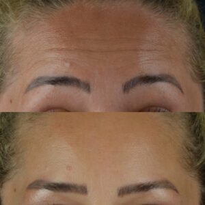 Botox-2-3-300x300
