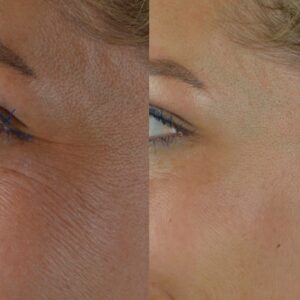 Botox-2-300x300