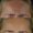 Botox-2-4-300x300