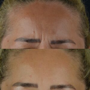 Botox-2-4-300x300