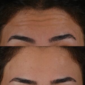 Botox-3-2-300x300