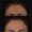 Botox-3-300x300