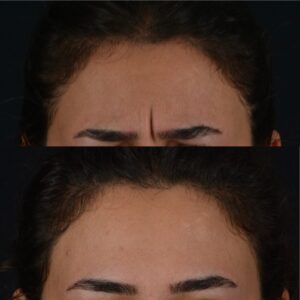 Botox-3-300x300