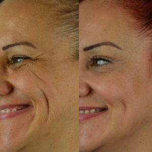 Botox-4-300x300