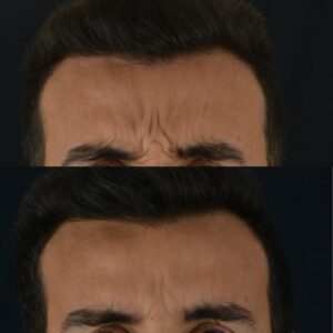 Botox-5-1-300x300