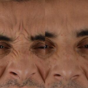 Botox-5-2-1-300x300