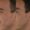 Botox-5-3-300x300