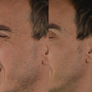 Botox-5-3-300x300