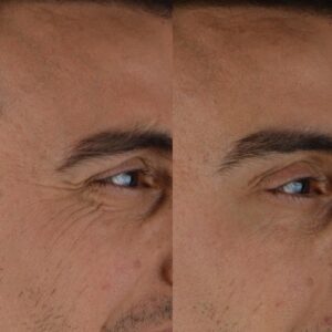 Botox-5-4-1-300x300
