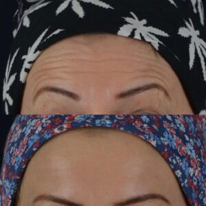 Botox-6-2-300x300
