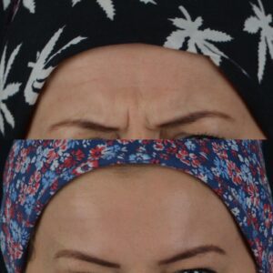 Botox-6-3-300x300