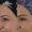 Botox-6-300x300