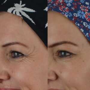 Botox-6-300x300