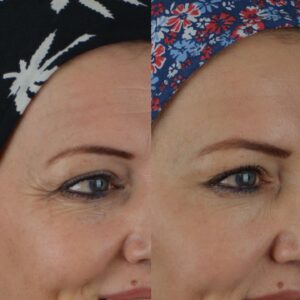 Botox-6-4-300x300