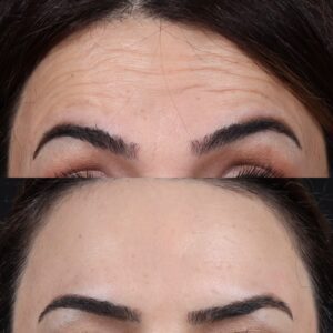 Botox-7-birlesmis-hali-1-300x300