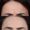 Botox-7-birlesmis-hali-2-1-300x300