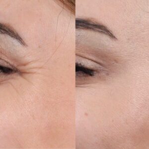 Botox-7-birlesmis-hali-3-1-300x300