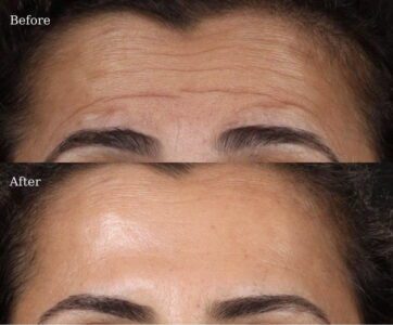 Botox-8-2-362x300