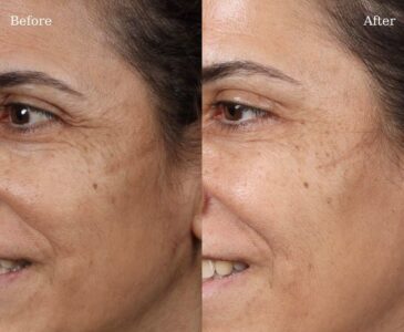 Botox-8-3-365x300