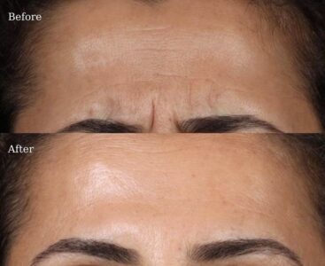 Botox-8-367x300