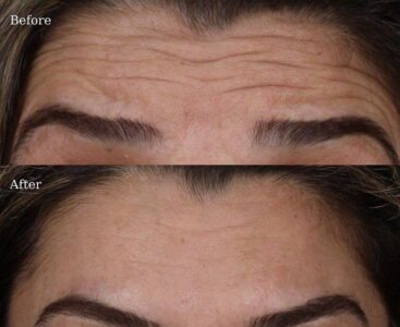Botox-9-2-367x300