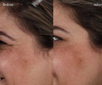 Botox-9-3-358x300