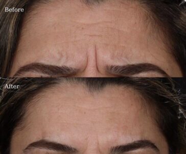 Botox-9-364x300