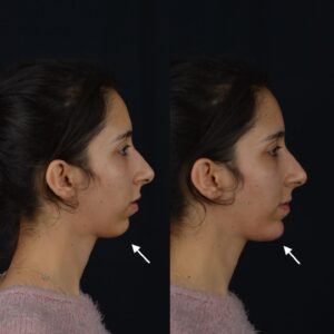 Dolgu-uygulamalari-cene-ucu-dolgusu-300x300