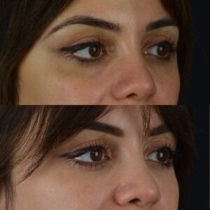 Dolgu-uygulamalari-goz-alti-isik-dolgusu-3-300x300