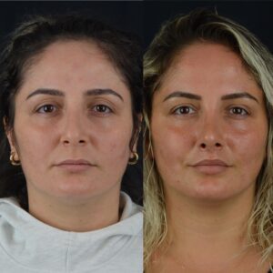 Dudak-kaldirma-1-Liplift-300x300