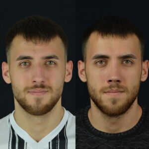 Erkek-Rinoplasti-3-birlestirilmis-hali-2-300x300