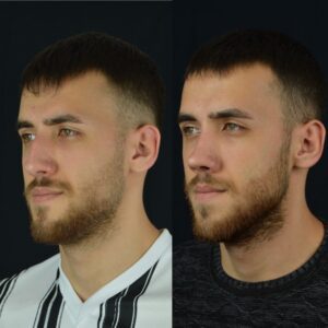 Erkek-Rinoplasti-3-birlestirilmis-hali-3-300x300