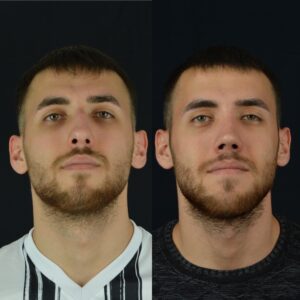 Erkek-Rinoplasti-3-birlestirilmis-hali--300x300