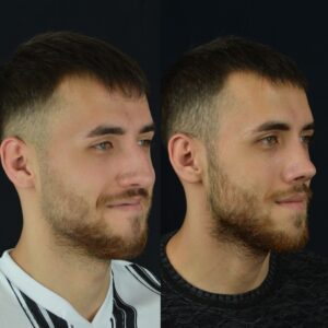 Erkek-Rinoplasti-3-birlestirilmis-hali-4-300x300