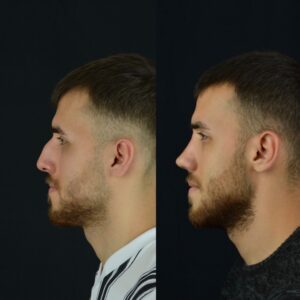 Erkek-Rinoplasti-3-birlestirilmis-hali-5-300x300