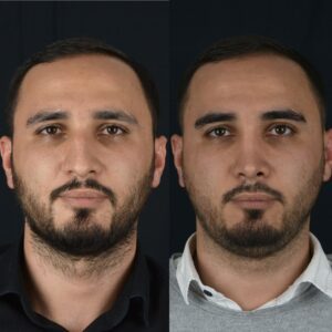 Erkek-Rinoplasti-4-2-300x300