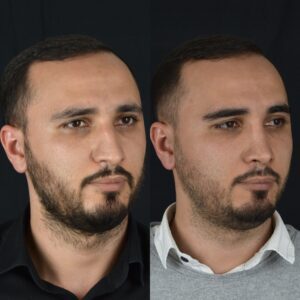 Erkek-Rinoplasti-4-3-300x300