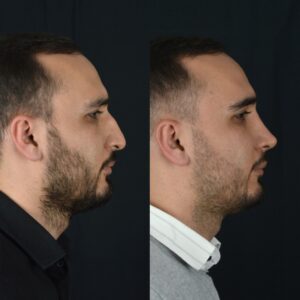Erkek-Rinoplasti-4-300x300
