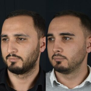 Erkek-Rinoplasti-4-4-300x300