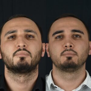 Erkek-Rinoplasti-4-5-300x300