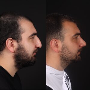 Erkek-Rinoplasti-5-2-300x300